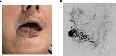 Combining superselective catheterization and electrochemotherapy: A new technological approach to the treatment of high-flow head and neck vascular malformations